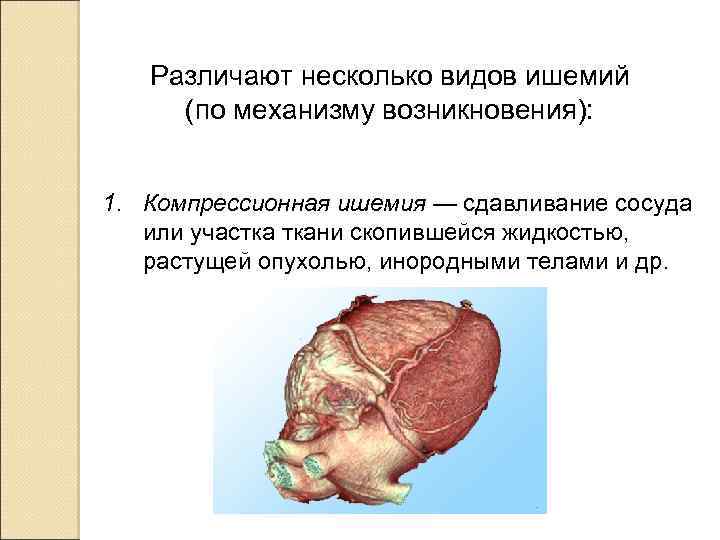 Различают несколько видов ишемий (по механизму возникновения): 1. Компрессионная ишемия — сдавливание сосуда или