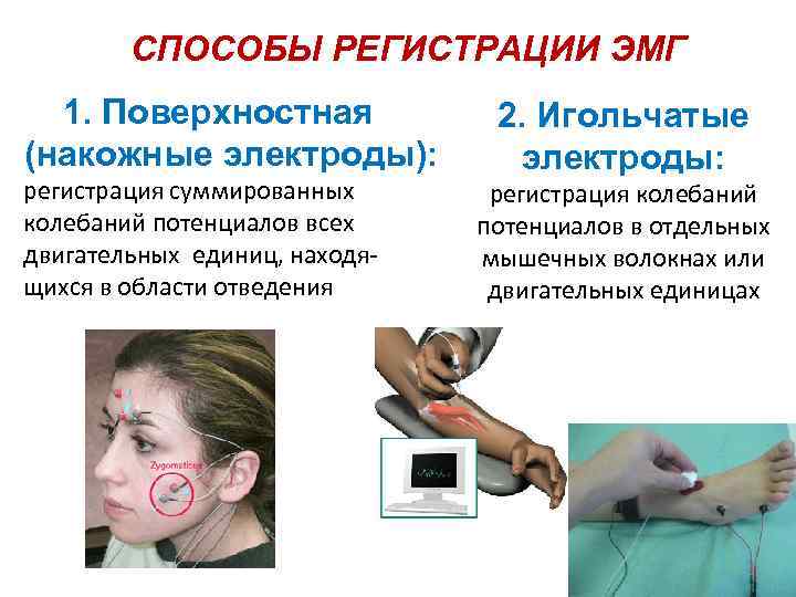 СПОСОБЫ РЕГИСТРАЦИИ ЭМГ 1. Поверхностная (накожные электроды): регистрация суммированных колебаний потенциалов всех двигательных единиц,