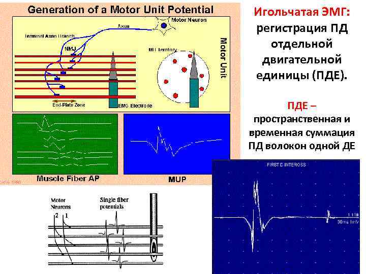 Игольчатая ЭМГ: регистрация ПД отдельной двигательной единицы (ПДЕ). ПДЕ – пространственная и временная суммация