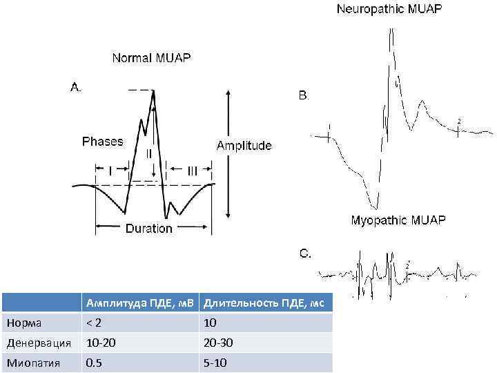 Амплитуда ПДЕ, м. В Длительность ПДЕ, мс Норма < 2 10 Денервация 10 -20