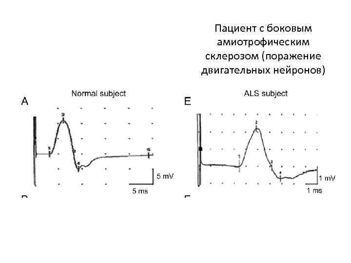 Пациент с боковым амиотрофическим склерозом (поражение двигательных нейронов) 