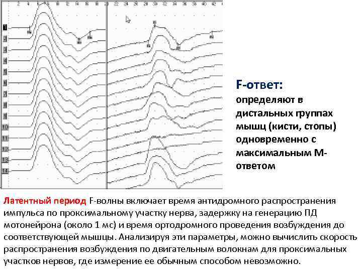 F-ответ: определяют в дистальных группах мышц (кисти, стопы) одновременно с максимальным Мответом Латентный период
