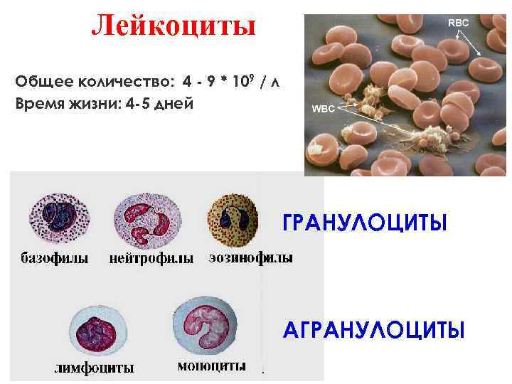 Особенность картины периферической крови при висцеральной форме лейшманиоза