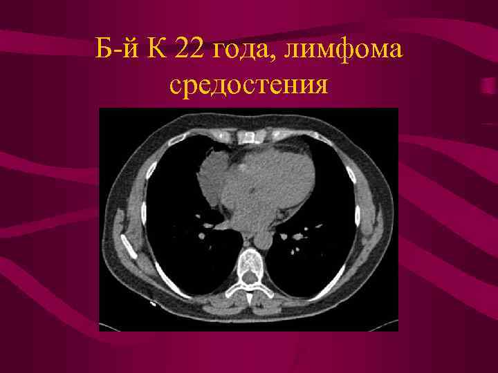 Б-й К 22 года, лимфома средостения 