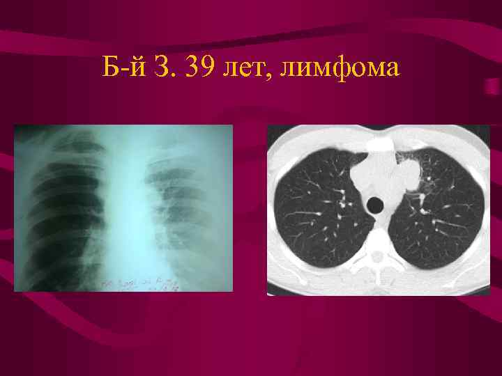 Б-й З. 39 лет, лимфома 