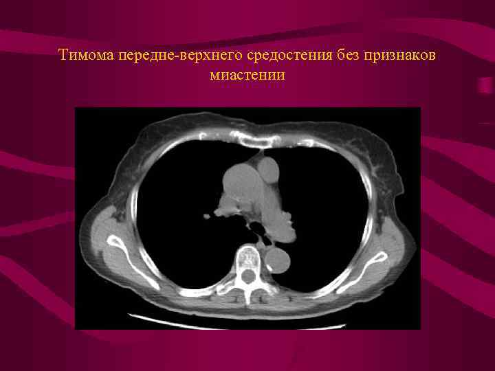Тимома передне-верхнего средостения без признаков миастении 