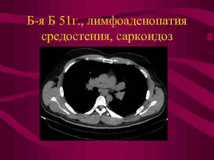 Б-я Б 51 г. , лимфоаденопатия средостения, саркоидоз 