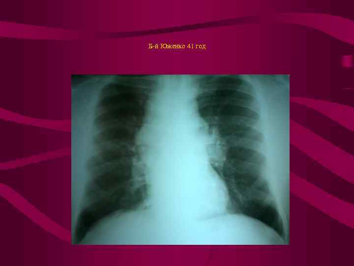 Б-й Юженко 41 год 