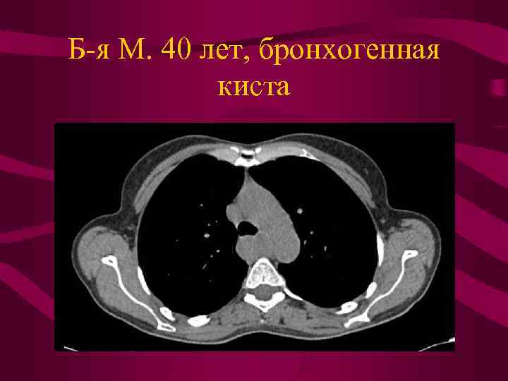 Киста задней стенки средостения