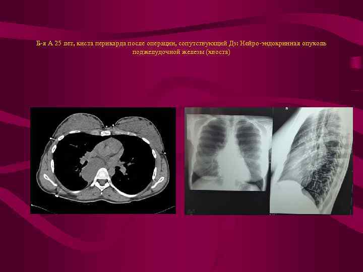 Б-я А 25 лет, киста перикарда после операции, сопутствующий Дз: Нейро-эндокринная опухоль поджелудочной железы
