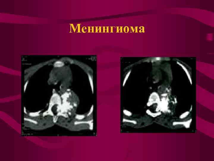 Менингиома 