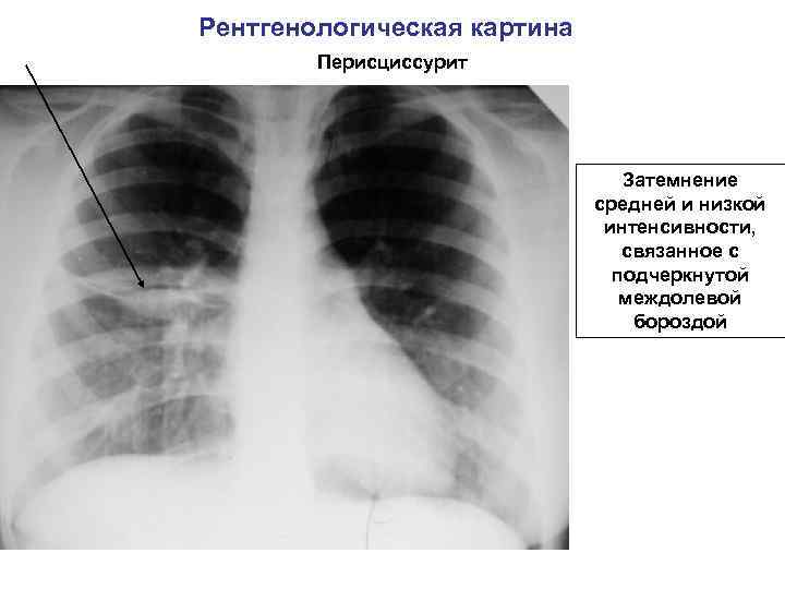 Рентгенологическая картина Перисциссурит Затемнение средней и низкой интенсивности, связанное с подчеркнутой междолевой бороздой 
