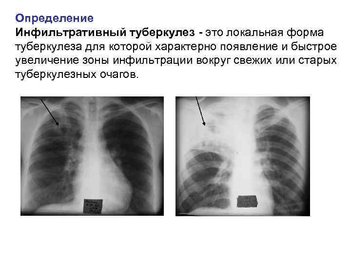 Определение Инфильтративный туберкулез - это локальная форма туберкулеза для которой характерно появление и быстрое