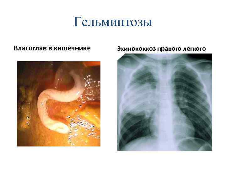 Гельминтозы Власоглав в кишечнике Эхинококкоз правого легкого 