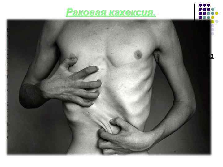 Раковая кахексия. Больные раком страдают от резчайшего исхудания за счет уменьшения массы жировой и