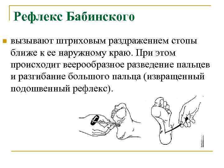 Рефлекс Бабинского n вызывают штриховым раздражением стопы ближе к ее наружному краю. При этом
