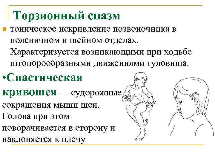 Торзионный спазм n тоническое искривление позвоночника в поясничном и шейном отделах. Характеризуется возникающими при