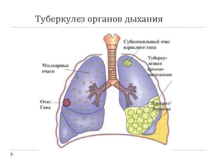 Туберкулез органов дыхания 