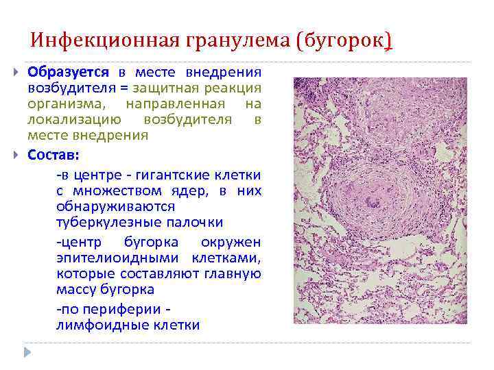 Инфекционная гранулема (бугорок) Образуется в месте внедрения возбудителя = защитная реакция организма, направленная на