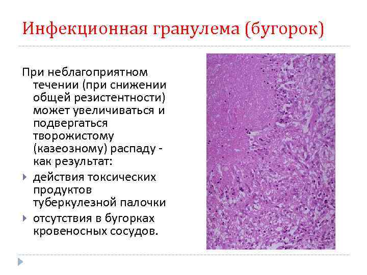 Инфекционная гранулема (бугорок) (бугорок При неблагоприятном течении (при снижении общей резистентности) может увеличиваться и