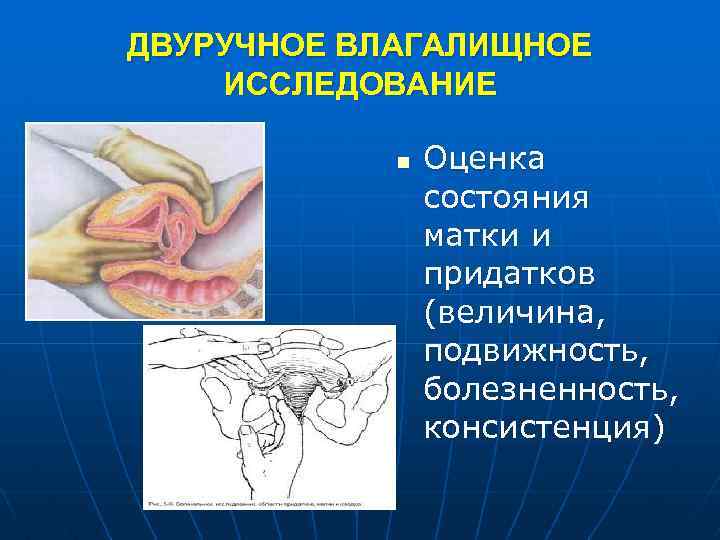 ДВУРУЧНОЕ ВЛАГАЛИЩНОЕ ИССЛЕДОВАНИЕ n Оценка состояния матки и придатков (величина, подвижность, болезненность, консистенция) 