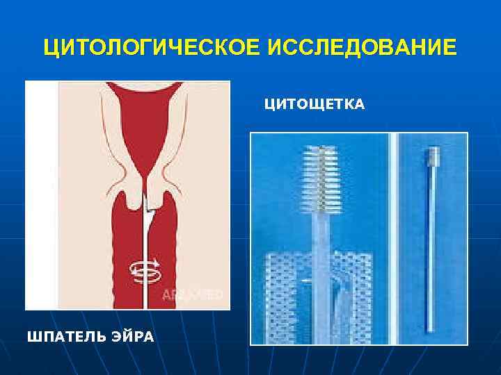 ЦИТОЛОГИЧЕСКОЕ ИССЛЕДОВАНИЕ ЦИТОЩЕТКА ШПАТЕЛЬ ЭЙРА 