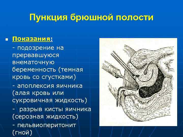 Абдоминальная пункция картинки