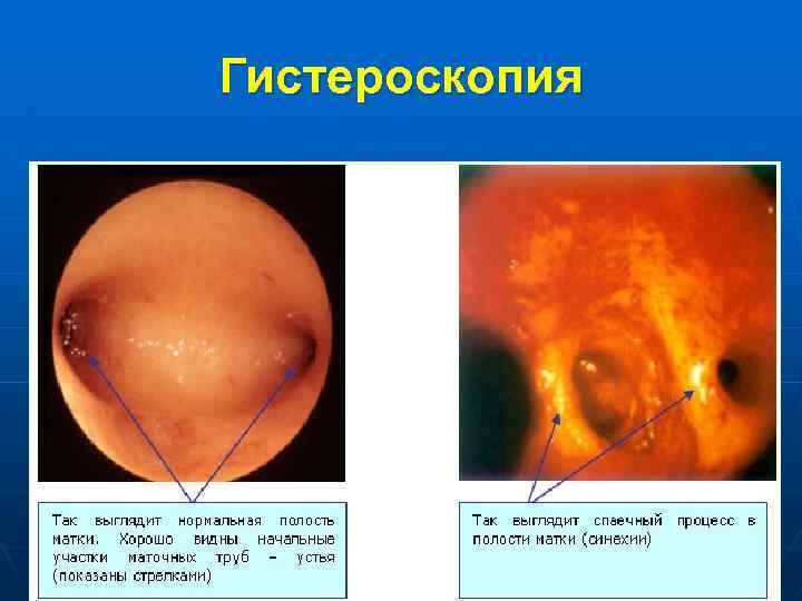 Гистероскопия 