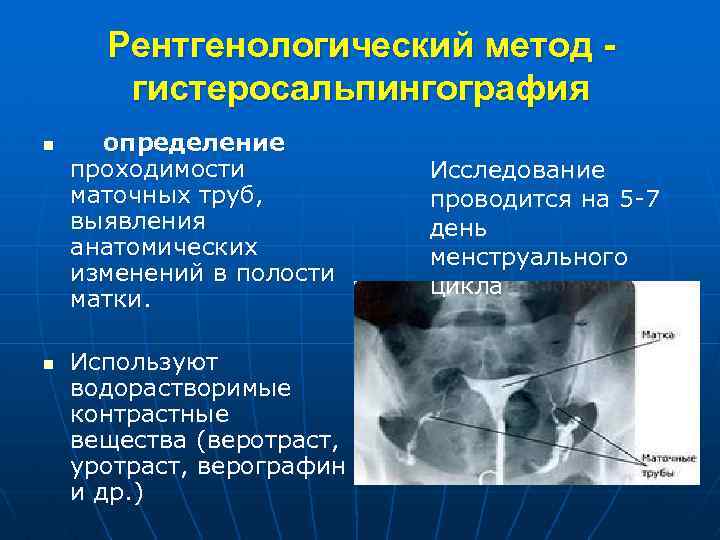 Рентгенологический метод гистеросальпингография n n определение проходимости маточных труб, выявления анатомических изменений в полости