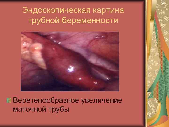 Эндоскопическая картина трубной беременности Веретенообразное увеличение маточной трубы 