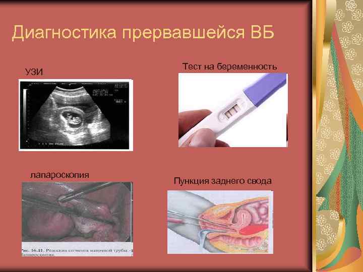 Диагностика прервавшейся ВБ УЗИ лапароскопия Тест на беременность Пункция заднего свода 