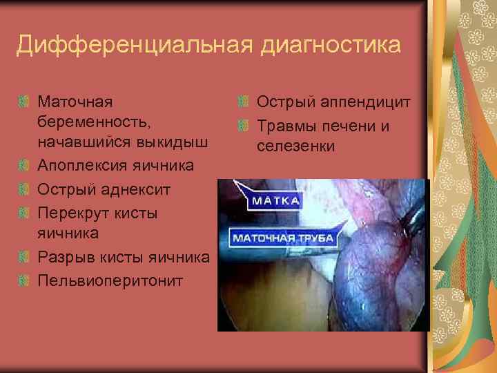 Дифференциальная диагностика Маточная беременность, начавшийся выкидыш Апоплексия яичника Острый аднексит Перекрут кисты яичника Разрыв