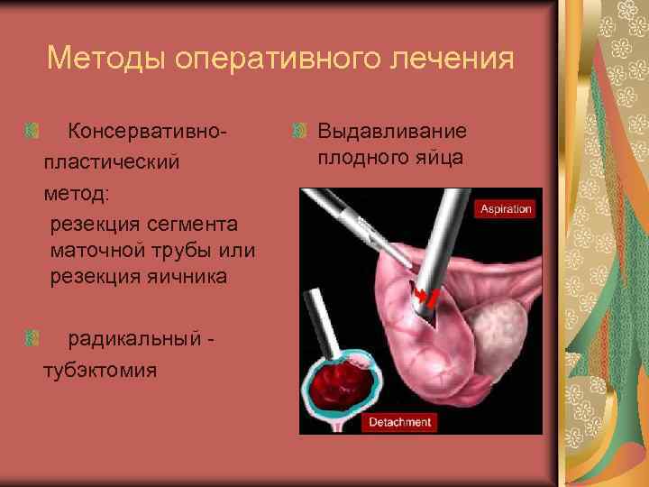 Методы оперативного лечения Консервативнопластический метод: резекция сегмента маточной трубы или резекция яичника радикальный тубэктомия