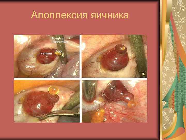 Апоплексия яичника 