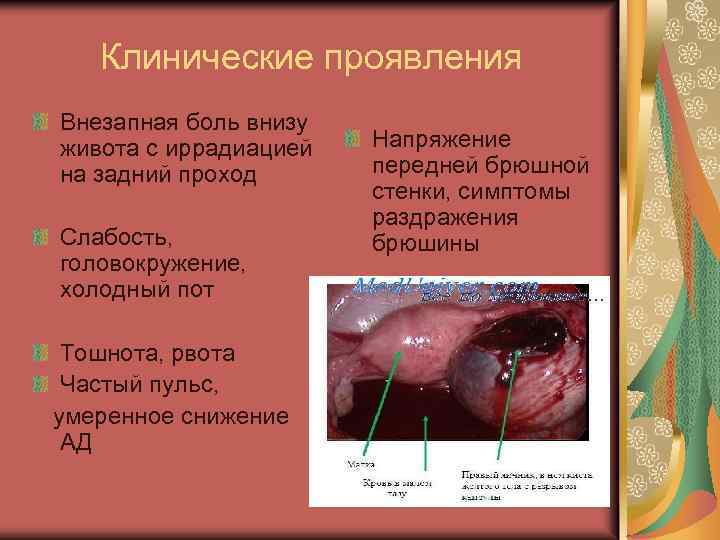 Клинические проявления Внезапная боль внизу живота с иррадиацией на задний проход Слабость, головокружение, холодный