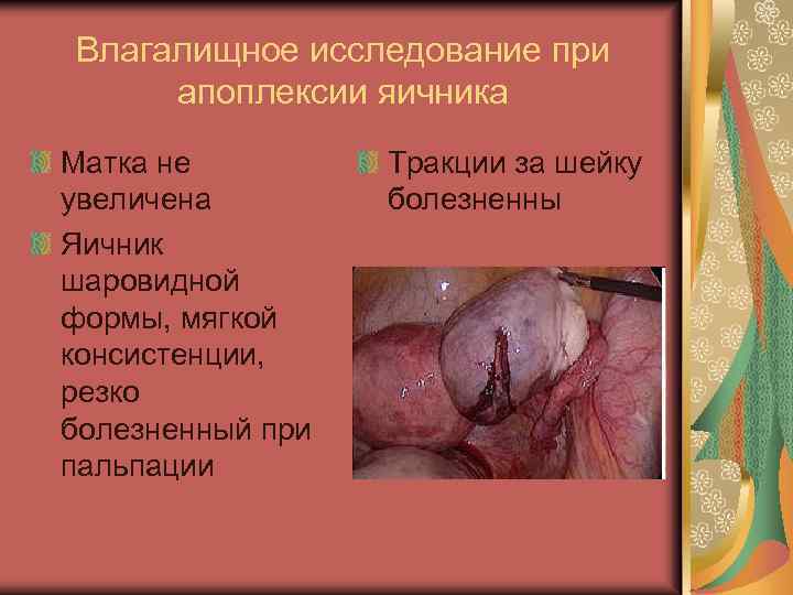 Влагалищное исследование при апоплексии яичника Матка не увеличена Яичник шаровидной формы, мягкой консистенции, резко
