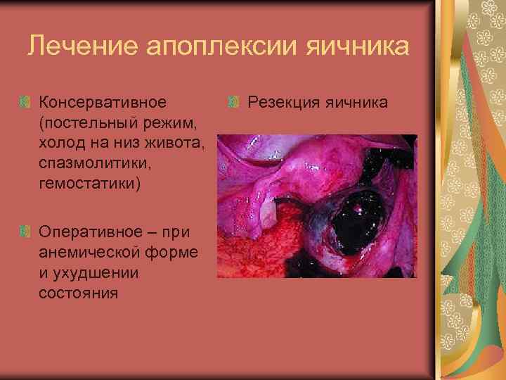 Лечение апоплексии яичника Консервативное (постельный режим, холод на низ живота, спазмолитики, гемостатики) Оперативное –