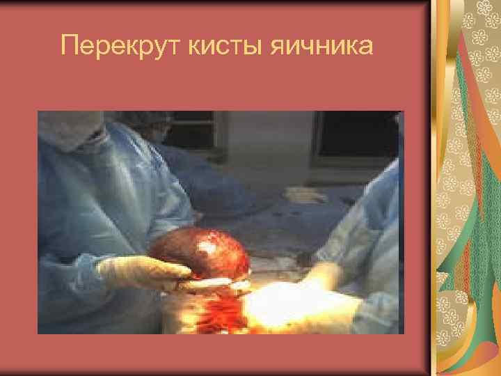 Перекрут кисты яичника 