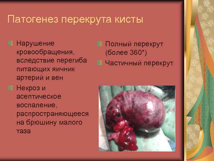 Патогенез перекрута кисты Нарушение кровообращения, вследствие перегиба питающих яичник артерий и вен Некроз и