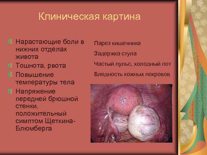 Клиническая картина Нарастающие боли в нижних отделах живота Тошнота, рвота Повышение температуры тела Напряжение