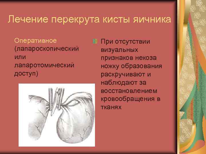 Лечение перекрута кисты яичника Оперативное (лапароскопический или лапаротомический доступ) При отсутствии визуальных признаков некоза