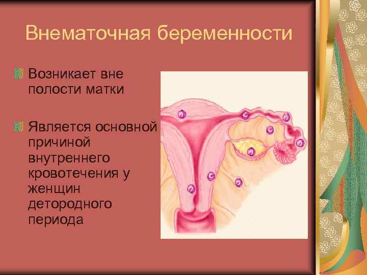 Внематочная беременности Возникает вне полости матки Является основной причиной внутреннего кровотечения у женщин детородного