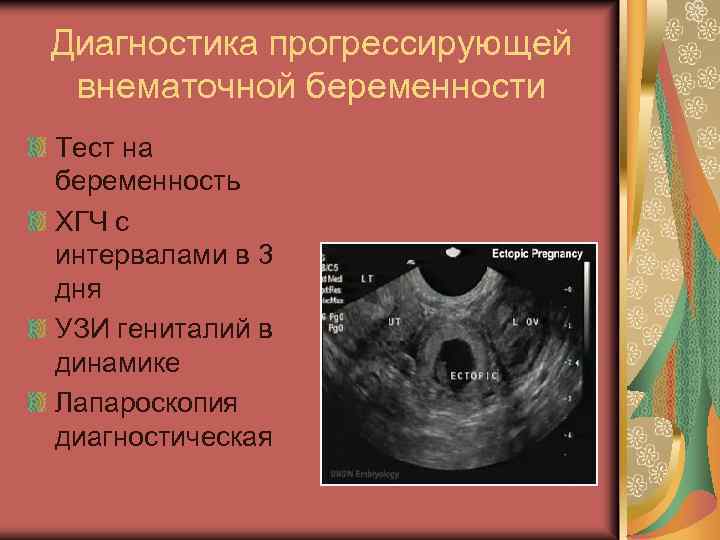Диагностика прогрессирующей внематочной беременности Тест на беременность ХГЧ с интервалами в 3 дня УЗИ