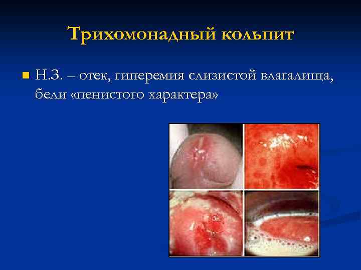 Трихомонадный кольпит n Н. З. – отек, гиперемия слизистой влагалища, бели «пенистого характера» 