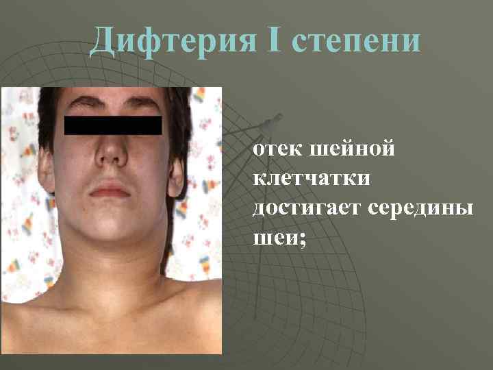 Дифтерия I степени отек шейной клетчатки достигает середины шеи; 