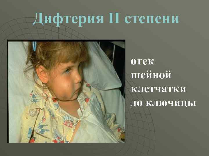 Дифтерия II степени отек шейной клетчатки до ключицы 