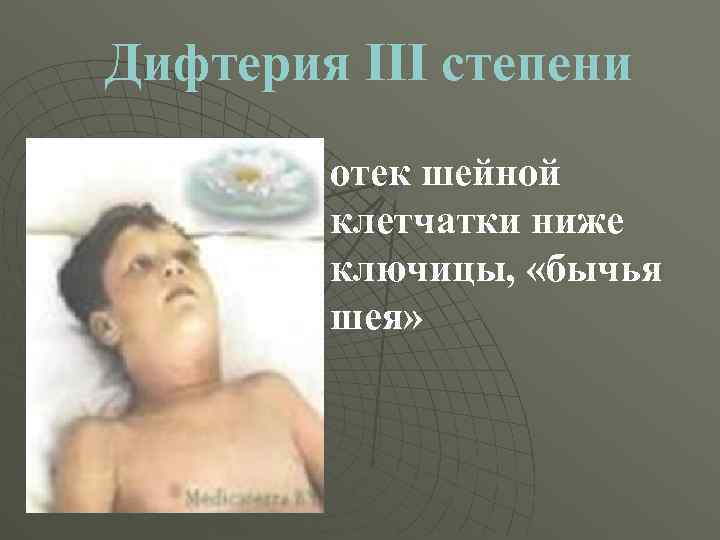 Дифтерия III степени отек шейной клетчатки ниже ключицы, «бычья шея» 