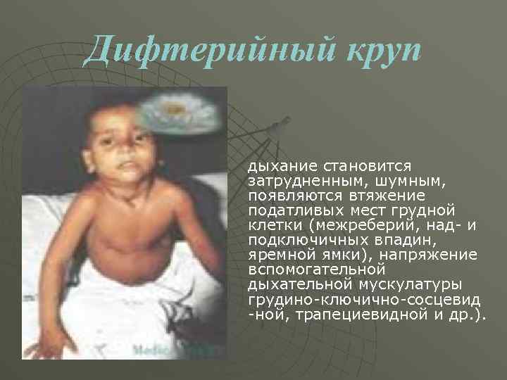 Дифтерийный круп дыхание становится затрудненным, шумным, появляются втяжение податливых мест грудной клетки (межреберий, над-