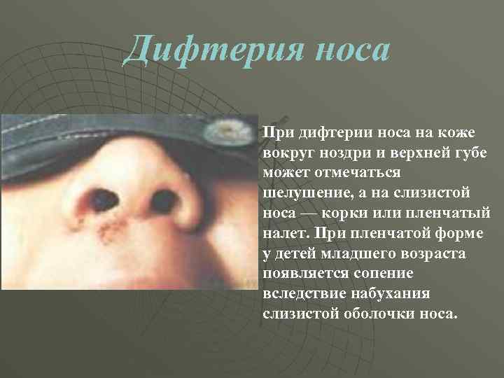 Дифтерия носа При дифтерии носа на коже вокруг ноздри и верхней губе может отмечаться