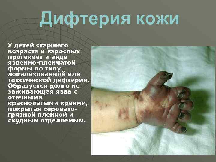Дифтерия кожи У детей старшего возраста и взрослых протекает в виде язвенно-пленчатой формы по